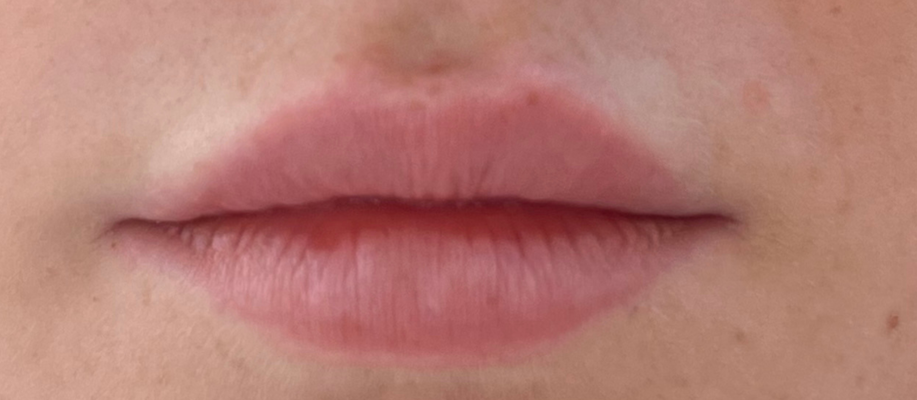 Lipfiller before